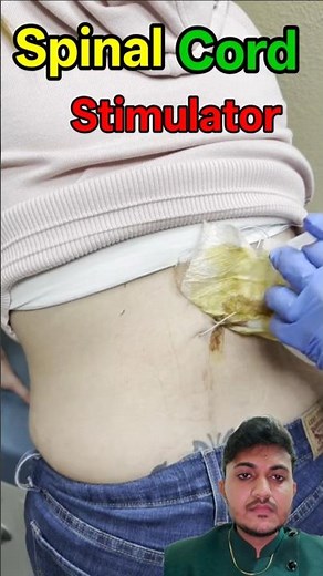 Spinal cord stimulator #sciatica #backpain #spinalcordstimulation