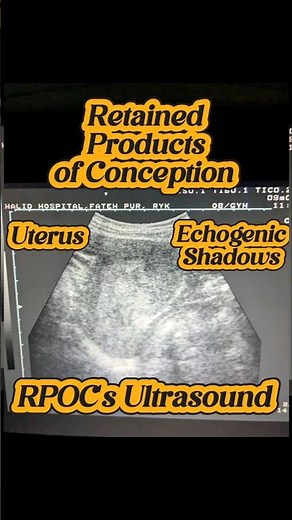 ultrasound Retained Products of Conception | RPOC's Scan | Clots in Uterus
