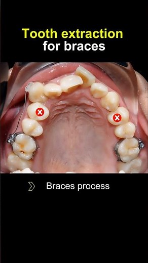 How to fix crooked teeth #braces #orthodontist #dentist #dentistry