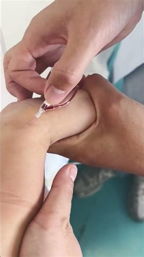 Perfect Blood Draw! 🩸 Success with the Butterfly Needle Technique #Shorts