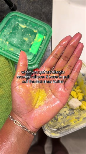 Real Shea Butter for Allergies Relief