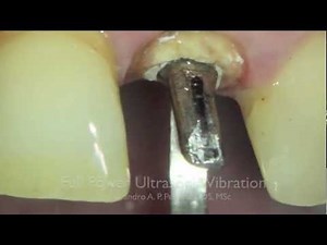 Cast Post Removal.mov