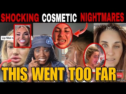 COSMETIC SURGERY GONE WRONG￼! BBL Fails, Turkey Teeth Veneer, Filler Migration & Botox Fail