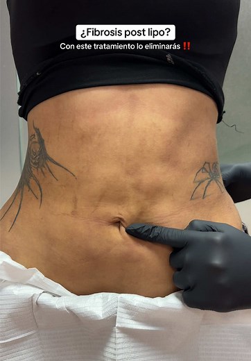 Elimina la fibrosis post lipo con enzimas recombinantes