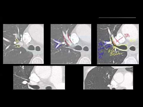 R Hilar lung anatomy on CT