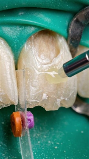 Rebuilding a Front Tooth Destroyed by Soda Instantly