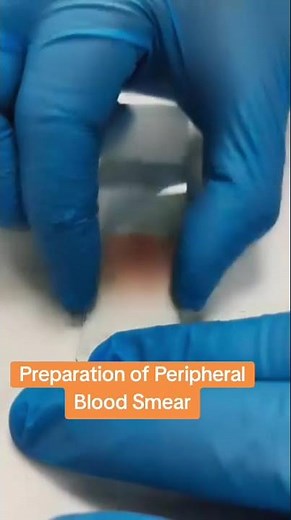 Preparation of Peripheral Blood Smear