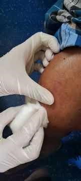 Bullae Rupture and clearing .