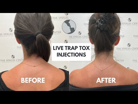 Slim Your Neck in Minutes with TrapTox!