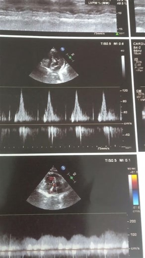 Color doppler Echocardiography