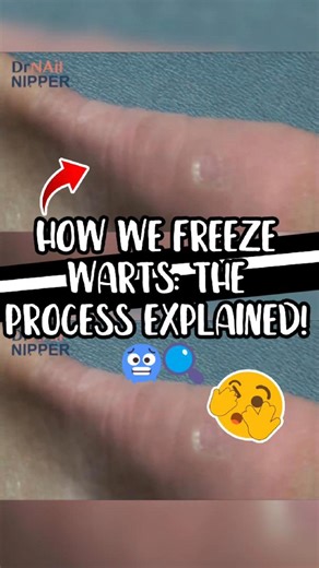 Dr Nail Nipper on Instagram: "How We Freeze Warts The Process Explained! 🥶🔍 In this video, we walk you through exactly how wart freezing (cryotherapy) works using a liquid nitrogen–based method. You’ll see how the freezing agent is applied, why it bubbles at room temperature, and how the freeze–thaw cycle helps destroy stubborn wart tissue. We also explain: • Why warts are harder to eliminate today • How long each freeze cycle lasts • Why thawing and repeating improves results • And when a ban