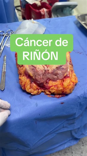 Cáncer de Riñón: Tratamientos y Cirugías Efectivas