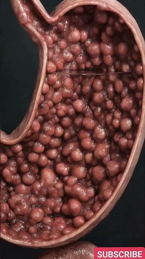 Stomach Cancer Explained | Symptoms, Causes, Diagnosis & Treatment Options