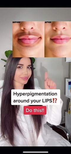 Do you have hyperpigmentation around your lips? Try these! #hyperpigmentationtreatment #hyperpigmentation #skincareroutine #darkspots
