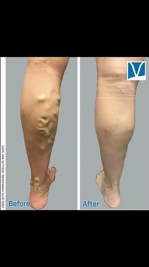 What happened to Nick Walker’s Calves?