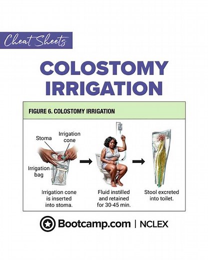 🚽 Colostomy Irrigation: NCLEX Must-Know for Ostomy Care | NCLEX Bootcamp Cheat Sheet