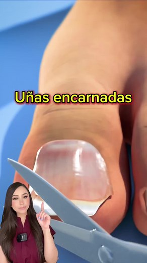 Cómo evitar uñas encarnadas: Consejos de corte