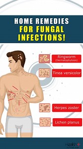 21K views · 176 reactions | Home Remedies For Fungal Infections! #healthcare #fungal #fitness #wellness | Health+ | Facebook