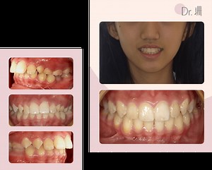 青少年 /兒童隱適美隱形矯正案例：深咬 / 小下巴 / Invialign MA