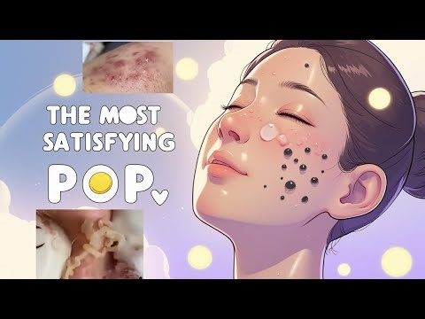 UNREAL PIMPLE EXPLOSIONS! 💥 Deep Cyst Pops You’ve NEVER Seen Before!