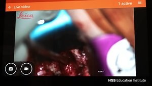 ACDF (Anterior Cervical Discectomy and Fusion)