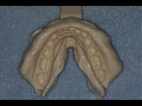 Accurate and Easy Alginate Impressions and Stone Casts
