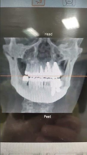 3D CT scan for teeth