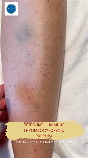 Dr Medica Clinical Cases || Petechiae — Immune thrombocytopenic purpura || Education || Medicine ||