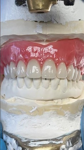 Wax Try-In with Posterior Bite Blocks #lsk121shorts #dentist #teeth