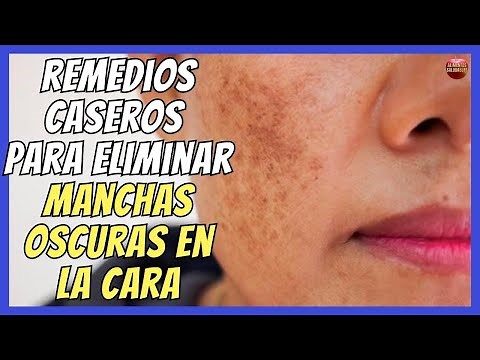 HOME REMEDIES TO REMOVE DARK SPOTS ON THE FACE