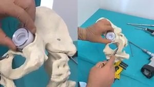 THA with Tripolar Constrained Acetabular Liner in a Composite Pelvis Model