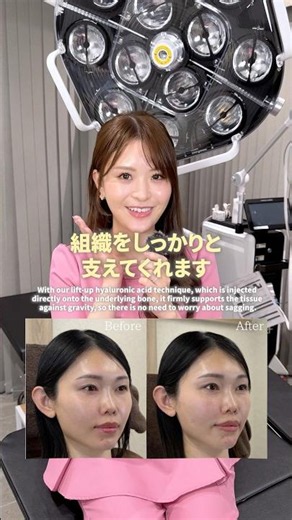 ヒアルロン酸って時間が経つと落ちてくるって本当？#ヒアルロン酸#美容#エイジングケア