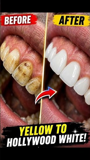 Satisfying Teeth Whitening Transformation ✨ #dentist #smiledesigndental #veneers #dentalartistry