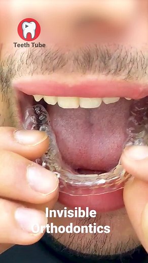 Invisible Orthodontics #invisibleorthodontics #straightteeth #dentist #orthodontist #teethtube
