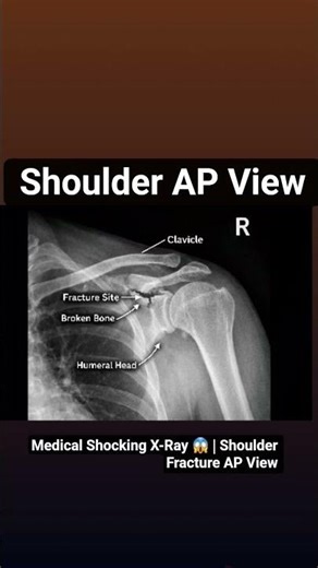 How to find fracture in shoulder AP view😱#ShoulderFracture#APViewXray#ShoulderXray#MedicalStudent