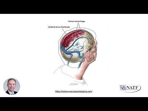 Cerebral Venous Sinus Thrombosis: A Patient Primer