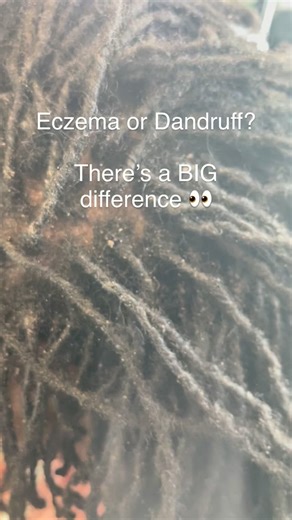 ✅Most people confuse eczema with dandruff, but they’re not the same. ➡️Dandruff is caused by oil buildup and yeast on the scalp, while eczema is an inflammatory condition that causes itching, flaking, and irritation that no shampoo alone can fix. ⬇️⬇️⬇️ If your scalp feels tight, scaly, or sore after washing, it may be time for a deeper look. 🙏🏾At Chopped, we focus on restoring scalp balance before styling, because healthy hair starts with a healthy foundation. ✨ Book your microloc consultatio