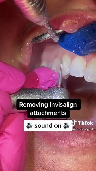 Removing Invisalign attachments #dentaldrill #invisalign #dmdomg #soundon #dentist #teeth #foryoupage #invisalignsmile