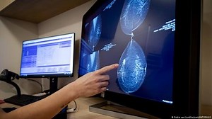 New AI model can predict 5-year breast cancer risk | Haystack News