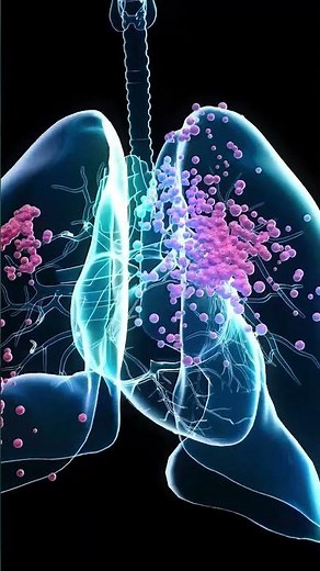 Complications of Influenza