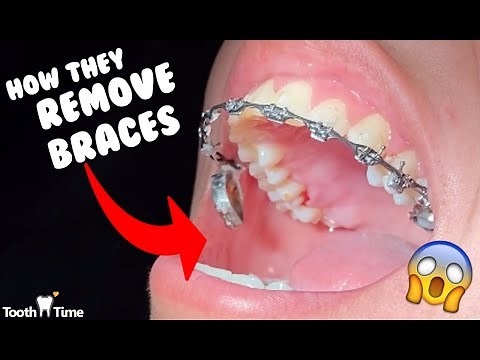 How they remove braces - Dental Braces Tooth Time Family Dentistry New Braunfels