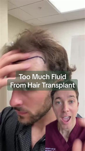 Why Using Too Much Tumescent Fluid During a Hair Transplant Can Be Risky Tumescent fluid is an important part of a hair transplant. It helps with anesthesia, bleeding control, and graft placement. But like anything in surgery, more is not always better. When too much tumescent solution is used, it can create real problems for the patient. Excessive tumescence can cause significant swelling, tissue distortion, and increased pressure in the scalp. When a patient experiences extreme or prolonged sw