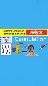 Expert Dialysis on Instagram: "🚨In this video, we explore the various cannulation techniques used for Arteriovenous Fistula (AVF) in dialysis. If you're a healthcare professional, a dialysis patient, or simply interested in understanding more about dialysis procedures, this video provides valuable insights into the most common and effective methods. Topics covered include: - **Buttonhole Technique:** Detailed explanation and benefits. - **Rope Ladder Technique:** Comprehensive guide and practic