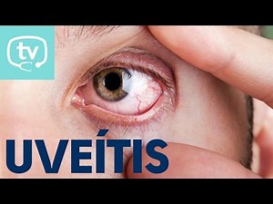 ¿Qué es la uveítis?