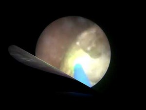 Holmium Laser Lithotripsy of Bladder Stone • Video • MEDtube.net