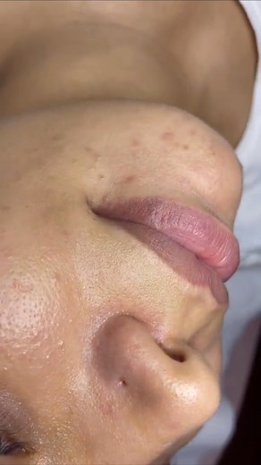 1.2K views · 94 reactions | HYDRAFACIAL  À l’aide de son système de...