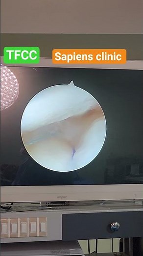 Arthroscopic TFCC repair #TFCC