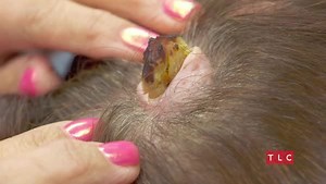 12M views · 62K reactions | Could it be serious? One horn-like growth has #DrPimplePopper deeply concerned this THURSDAY at 9/8c. | Dr. Pimple Popper | Facebook