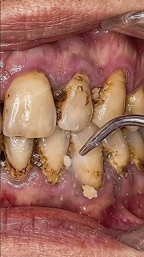 Dental Cleaning After 10 Years of Neglect!