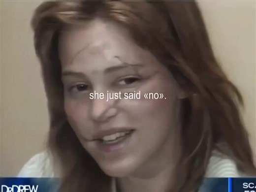 Marla Hanson was 24 when her former landlord hired two men to attack her with razor blades after a rent dispute and rejected romantic advances.They slashed her face, leaving permanent scars that ended her modeling career.During the trial, she refused to hide and appeared in court without makeup: “I wanted people to see what they had done.”All three men were convicted, and she later became a victims rights advocate.